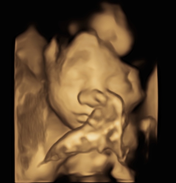 First cycle - IVF / ICSI - Day 4 