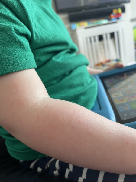 Small spots on toddler 