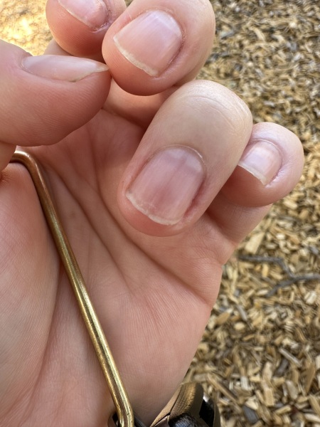 Vertical line on my fingernail