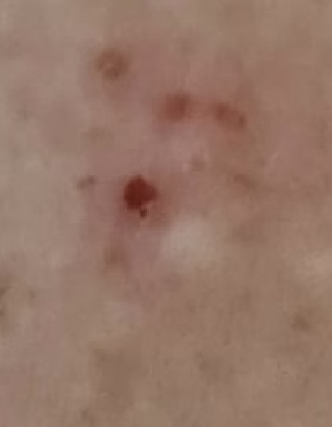Is this a dodgy mole?