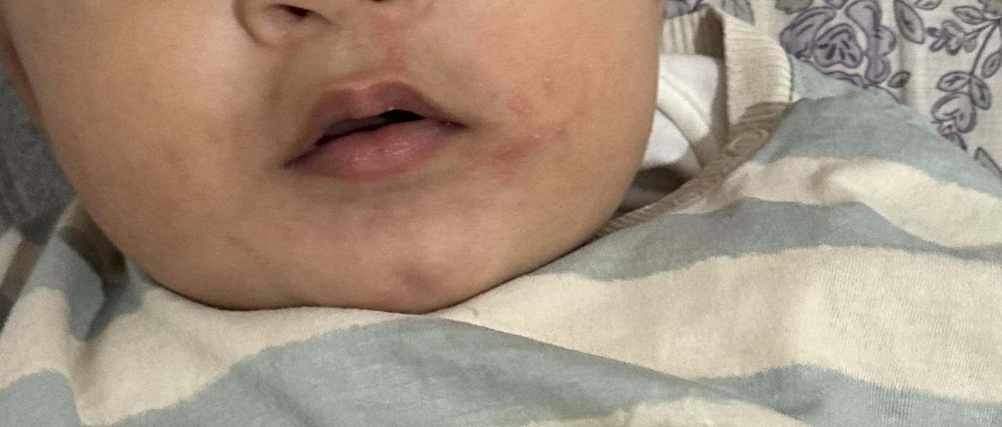 8 month old has a rash on his face and is really itchy