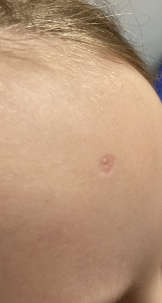 Large chicken pox scar