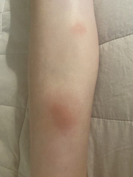 Taking antibiotics abroad in case of insect bite infection?