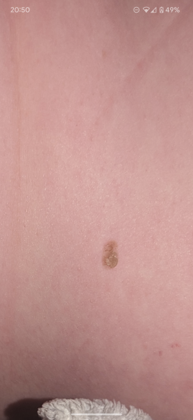 Something crusty on my back (not really sporny but warning anyway)