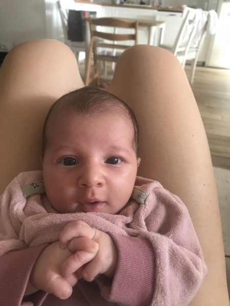 Baby's eyes different shape