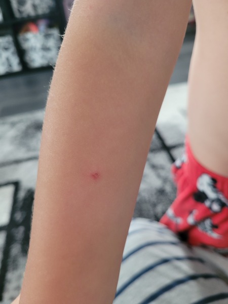 Chicken pox? Flea bites? Bed bugs? Mosquitos?