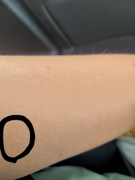 Pimples/bumpy skin when ageing