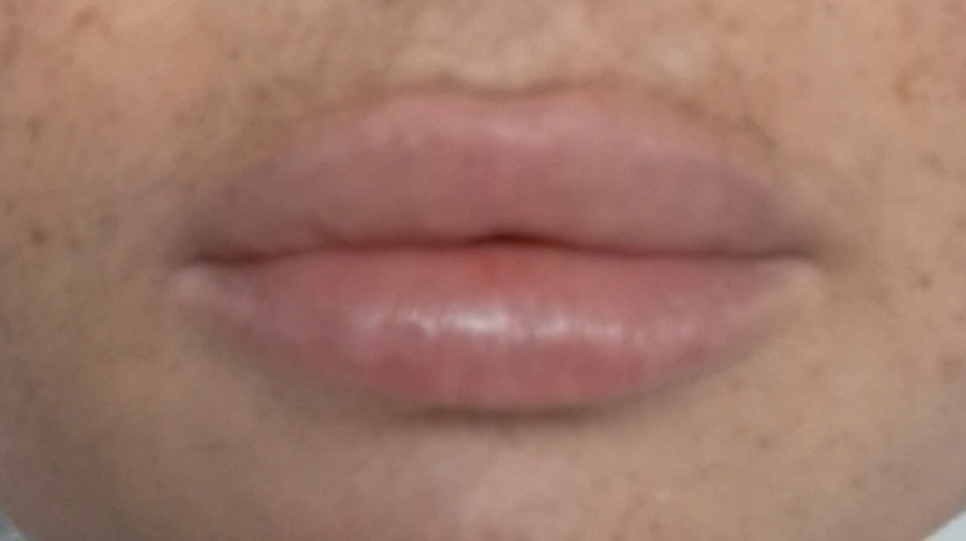 Lip fillers