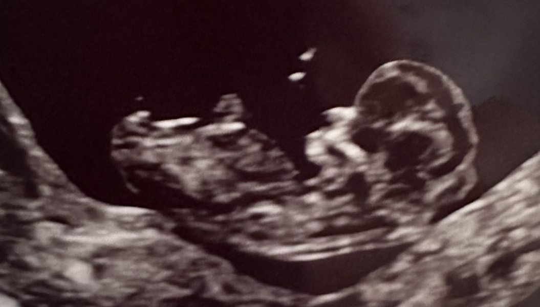 Girl or Boy Nub in Scan