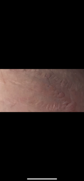  photo of them attached - can this happen to stretch marks? Or is it something else?