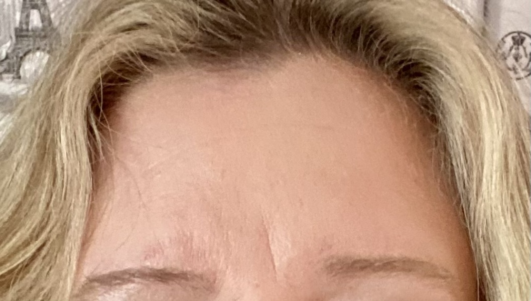 Best solution for vertical frown line? (Pic)