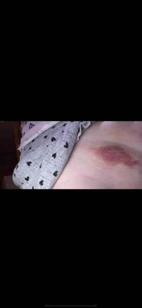 Endometriosis?