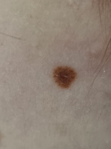 DD has a strange mole. How worried should I be?