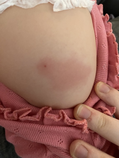 Injection site, is this normal 