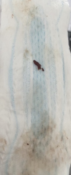 Implantation bleeding