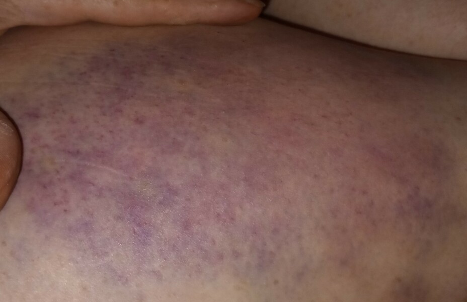 Massive bruise from bite