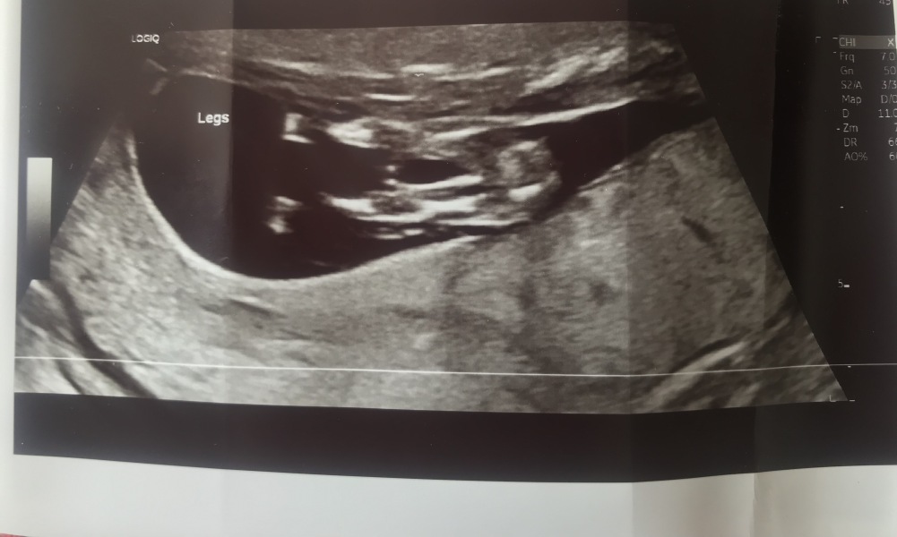 Pls would you guess our gender!!! Too excited to contain myself!!