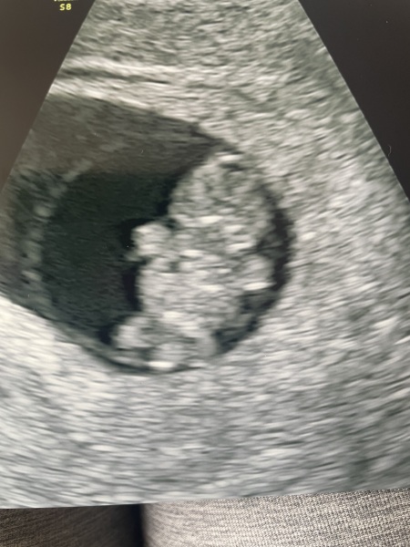 To book an early scan or wait it out?