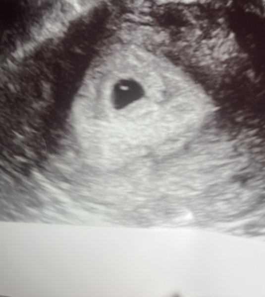 Hematoma and 6 weeks pregnant 