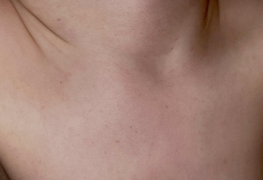 Petechiae