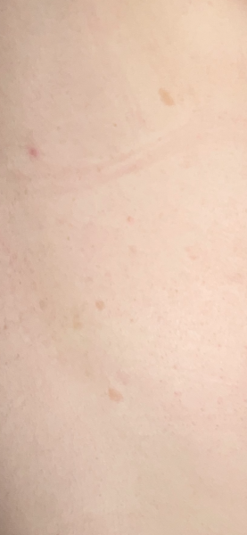 Brown patches of skin 