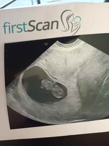 Can anyone share 8 week scan pictures?