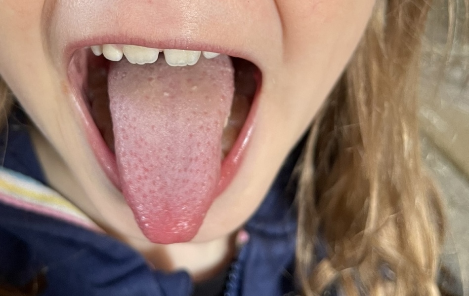 Strep A?