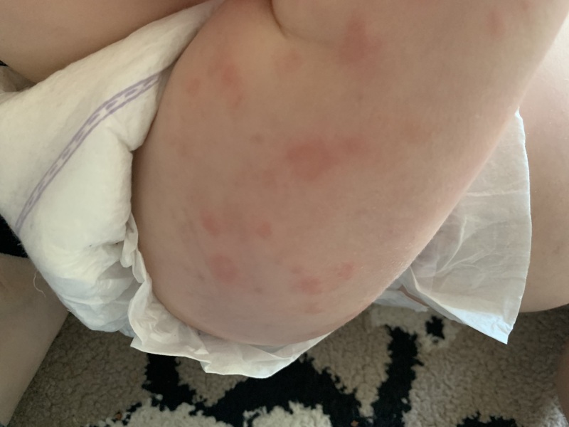 DD rash