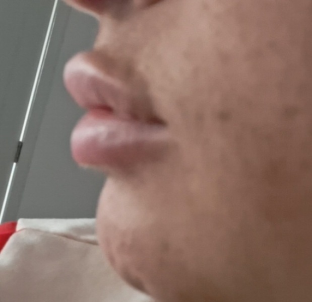 Lip fillers