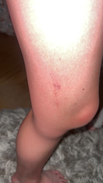 Bruise and rash
