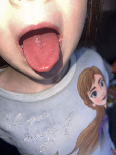 Strawberry tongue