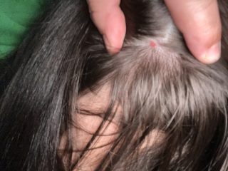 Any ideas what this is on scalp?