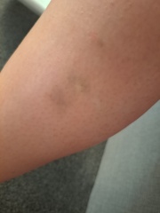 Bruising - Anyone else? Advice?
