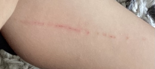 Cat scratch now panicking 