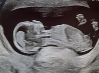 BOY OR GIRL? Nub theory?