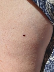 Would you get this freckle looked at ?