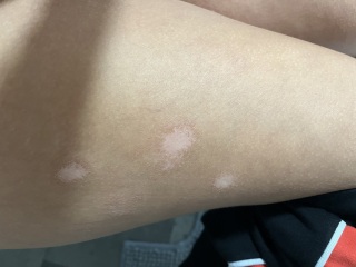 Help please skin patches !!!!