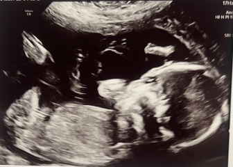 Gender scan, boy or girl?