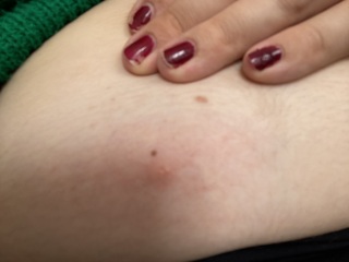 Help what bites are these 