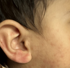 MMR vaccine rash? and low temp of 35.5 at night - PLEASE SEE PICS