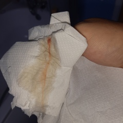 38+6 and mucus plug? 