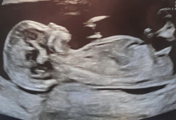 BOY OR GIRL? Nub theory?