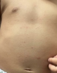 MMR vaccine rash? and low temp of 35.5 at night - PLEASE SEE PICS