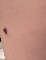 Mole changes - when to get checked