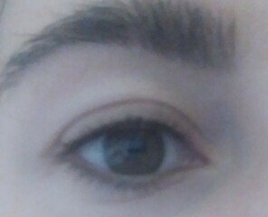 Sagging eyelids in early 30s