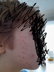 Rash on child's face - please help!