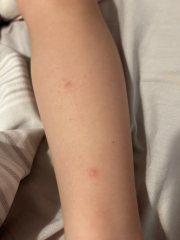 Spots on 2yo’s arm and legs