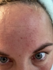 Suddenly greasy face with tiny whiteheads 