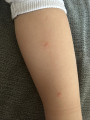 Spots on 2yo’s arm and legs