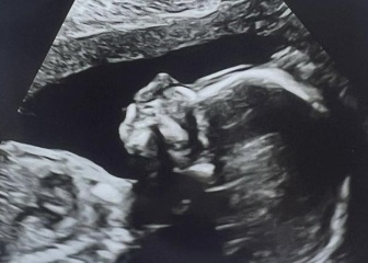 Boy or Girl?